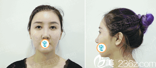 面部提升+线雕隆鼻术前照 面部提升+线雕隆鼻术前照