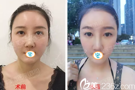 面部埋线提升+埋线隆鼻手术前后对比 面部埋线提升+埋线隆鼻手术前后对比