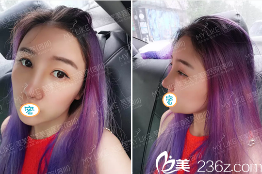 成都美莱谢仕乔面部线雕提升术后效果 成都美莱谢仕乔面部线雕提升术后效果