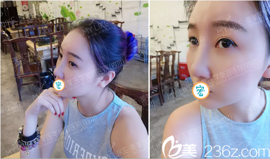 成都美莱谢仕乔面面部埋线提升+线雕隆鼻术后15天 大家给我的变化打几分？