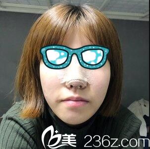 韩国清潭整形外科李丙玟鼻综合真人案例术后第三天
