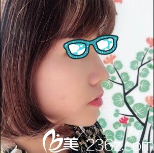 韩国清潭整形外科李丙玟鼻综合真人案例术后第七天