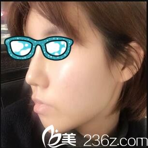 韩国清潭整形外科李丙玟鼻综合真人案例术后第九天