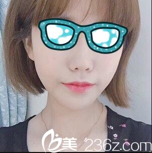 韩国清潭整形外科李丙玟鼻综合真人案例术后十八天