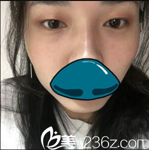 韩国清潭整形外科成镇模双眼皮真人案例 韩国清潭整形外科成镇模双眼皮真人案例