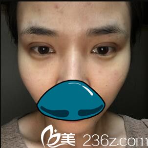 韩国清潭整形外科成镇模双眼皮真人案例术后天 韩国清潭整形外科成镇模双眼皮真人案例术后天