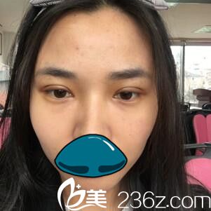 韩国清潭整形外科成镇模双眼皮真人案例术后第三天 韩国清潭整形外科成镇模双眼皮真人案例术后第三天