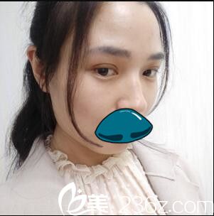 韩国清潭整形外科成镇模双眼皮真人案例术后第五天 韩国清潭整形外科成镇模双眼皮真人案例术后第五天