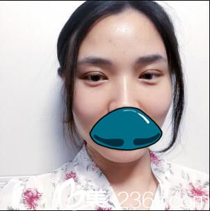 韩国清潭整形外科成镇模双眼皮真人案例术后第七天 韩国清潭整形外科成镇模双眼皮真人案例术后第七天