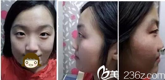 焦作丽人眼鼻整形术前 焦作丽人眼鼻整形术前