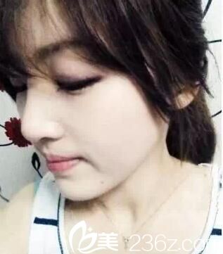 焦作丽人隆鼻手术后1个月 焦作丽人隆鼻手术后1个月