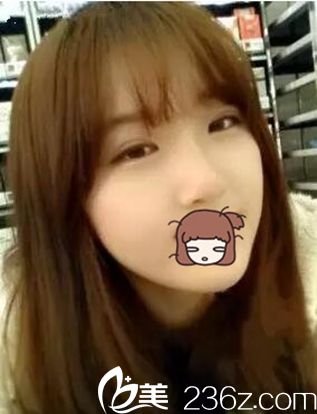 焦作丽人眼鼻整形术后2个月 焦作丽人眼鼻整形术后2个月