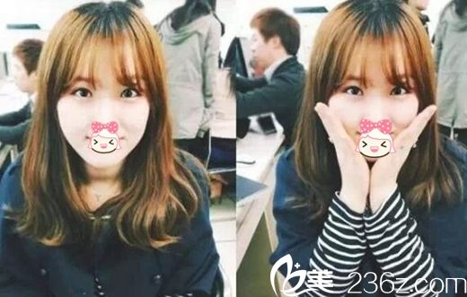 焦作丽人眼鼻整形案例 焦作丽人眼鼻整形案例