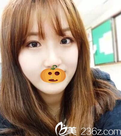 是焦作丽人让我拥有了迷人大眼和高挺鼻子 花这钱做眼鼻整形真值