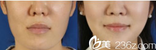 韩国Members整形外科医院案例 韩国Members整形外科医院案例