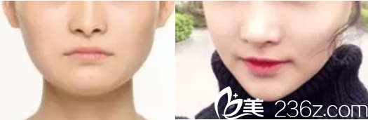 韩国Members整形外科医院案例 韩国Members整形外科医院案例