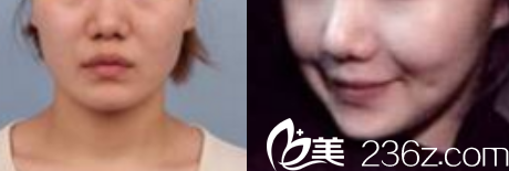 韩国Members整形外科医院案例 韩国Members整形外科医院案例