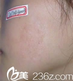 ​我看了公立的烧伤整形医院排名后，找漳州175医院的郑庆亦做了疤痕修复手术