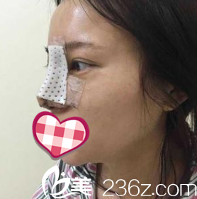 鼻整形手术当天照