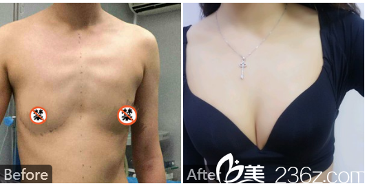 深圳南西子郑举卫自体脂肪隆胸案例