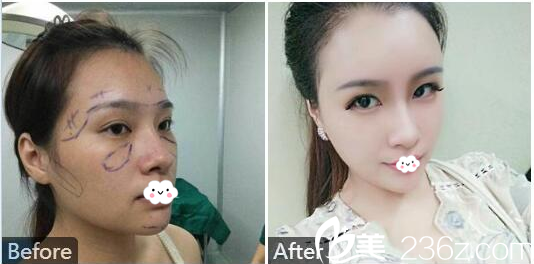 深圳南西子郑举卫自体脂肪填充全脸和PRP自体血清美肤案例