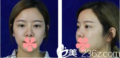 在<!--<i data=20240703-sp></i>-->整形医院做隆鼻术前照 在<!--<i data=20240703-sp></i>-->整形医院做隆鼻术前照