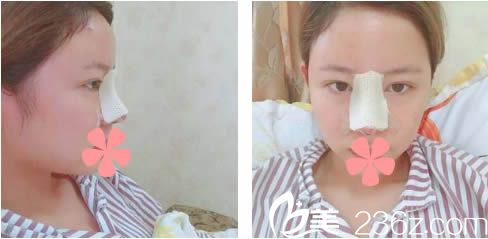 做完综合隆鼻术后第1天 做完综合隆鼻术后第1天