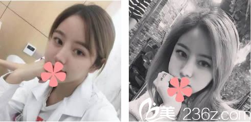 鼻综合隆鼻术后15天恢复效果 鼻综合隆鼻术后15天恢复效果