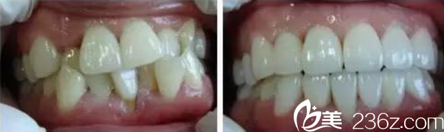 游春花医师牙齿矫正案例 游春花医师牙齿矫正案例