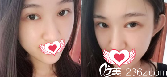在安庆石化医院割双眼皮+开内眼角术后第15天恢复效果展示