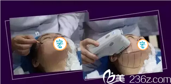 <!--<i data=20240703-sp></i>-->悦美治疗过程 <!--<i data=20240703-sp></i>-->悦美治疗过程