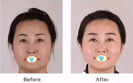 治疗术后半个月对比照片 治疗术后半个月对比照片