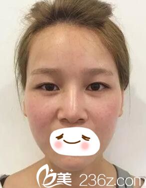 眼鼻修复术前效果不明显 眼鼻修复术前效果不明显