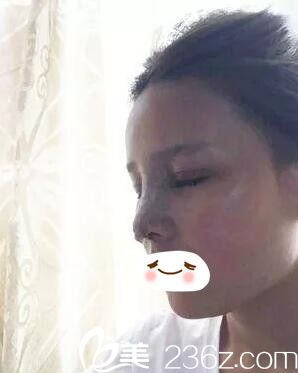 双眼皮+鼻综合术后即刻 双眼皮+鼻综合术后即刻