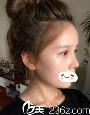 术后一周眼鼻恢复中 术后一周眼鼻恢复中