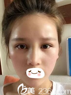 汪涌医生眼鼻修复术后半个月 汪涌医生眼鼻修复术后半个月