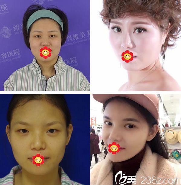 绍兴维美整形医院双眼皮真人案例 绍兴维美整形医院双眼皮真人案例