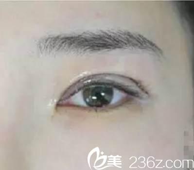 术后冰敷 术后冰敷