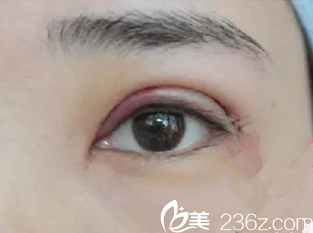 术后第二天 术后第二天