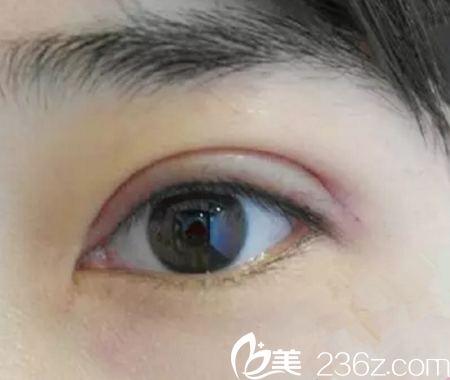 第七天拆线后 第七天拆线后