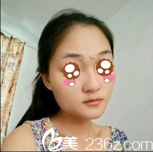 韩国BAO整形医院裴敬太鼻综合真人案例 韩国BAO整形医院裴敬太鼻综合真人案例