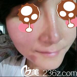 韩国BAO整形医院裴敬太鼻综合真人案例术后第五天 韩国BAO整形医院裴敬太鼻综合真人案例术后第五天