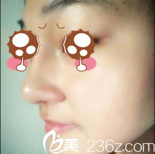 韩国BAO整形医院裴敬太鼻综合真人案例术后第十天 韩国BAO整形医院裴敬太鼻综合真人案例术后第十天