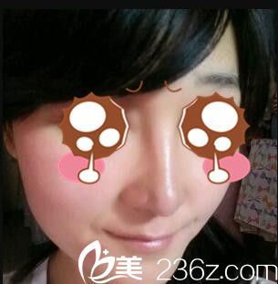 韩国BAO整形医院裴敬太鼻综合真人案例术后十五天 韩国BAO整形医院裴敬太鼻综合真人案例术后十五天