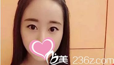 包头丽人医疗美容整形医院割双眼皮前 包头丽人医疗美容整形医院割双眼皮前