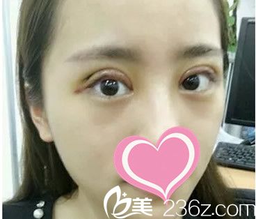 全切双眼皮第二天 全切双眼皮第二天