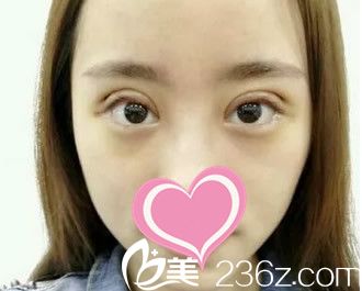 割双眼皮第三天 割双眼皮第三天