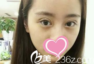 双眼皮第七天拆线后 双眼皮第七天拆线后