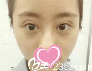 全切双眼皮第九天 全切双眼皮第九天