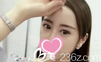 割双眼皮半个月了 割双眼皮半个月了